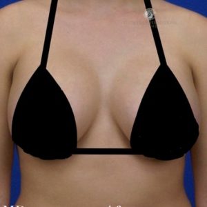 breast-augmentation-after-patient-palo-alto-ca