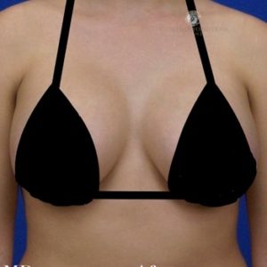 San Francisco Breast Augmentation After