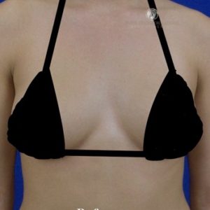 San Francisco Breast Augmentation Before