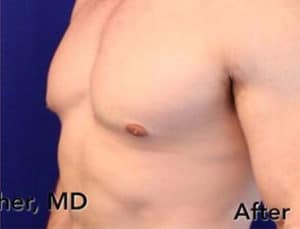 San Francisco Gynecomastia Surgery