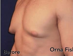 Male Breast Reduction | Gynecomastia Palo Alto CA