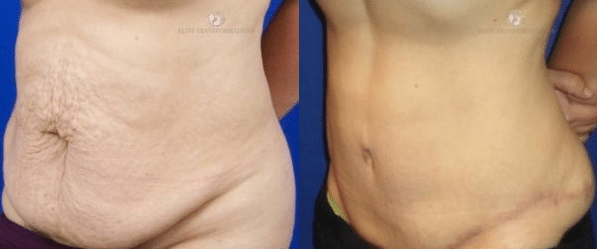 What Is A Tummy Tuck (Abdominoplasty)?