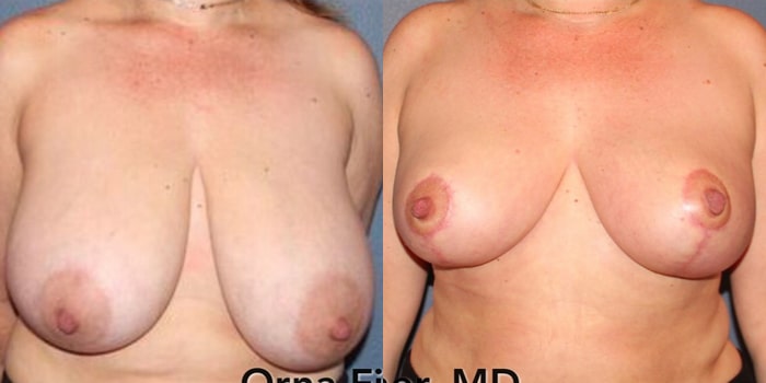 Breast Reduction Before and After