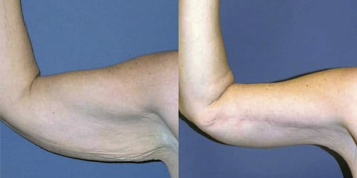 San Francisco Arm Lift Before and After 