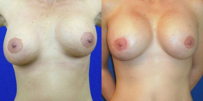 Breast Revision Surgery San Francisco | Breast Revision Palo Alto CA