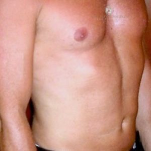 Liposuction Before & After San Francisco CA