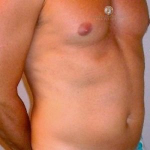 Liposuction Before & After San Francisco CA
