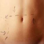 Tummy Tuck | San francisco