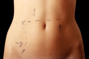 Tummy Tuck | San francisco 