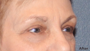 Blepharoplasty After