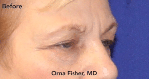 Blepharoplasty Before