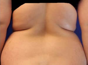 Liposuction Before & After San Francisco CA