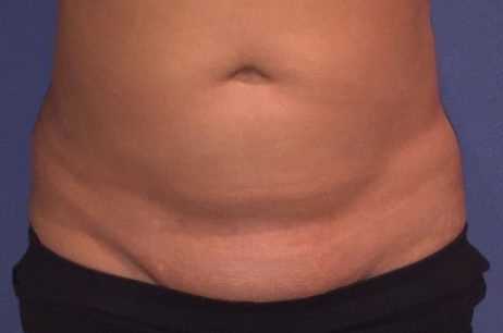 Pubic Fat Pad Removal - Mons Lift Liposuction