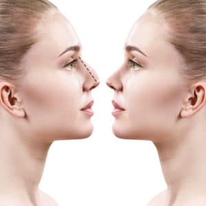 Rhinoplasty San Francisco CA | Palo Alto