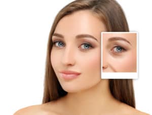 Blepharoplasty San Francisco CA