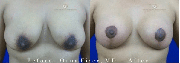 San Francisco Bay Area Breast Lift Before & After