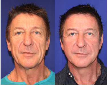 Facelift Before & After 