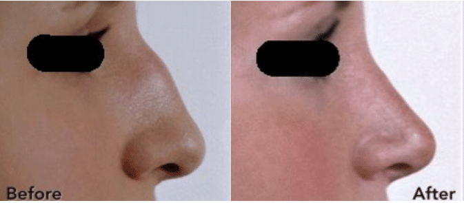 Rhinoplasty Before and After Palo Alto CA