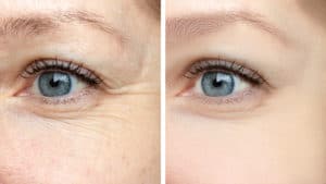 Blepharoplasty (Eye Lift) in San Francisco