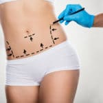 Tummy tuck