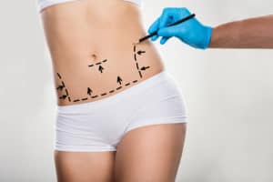 Tummy tuck