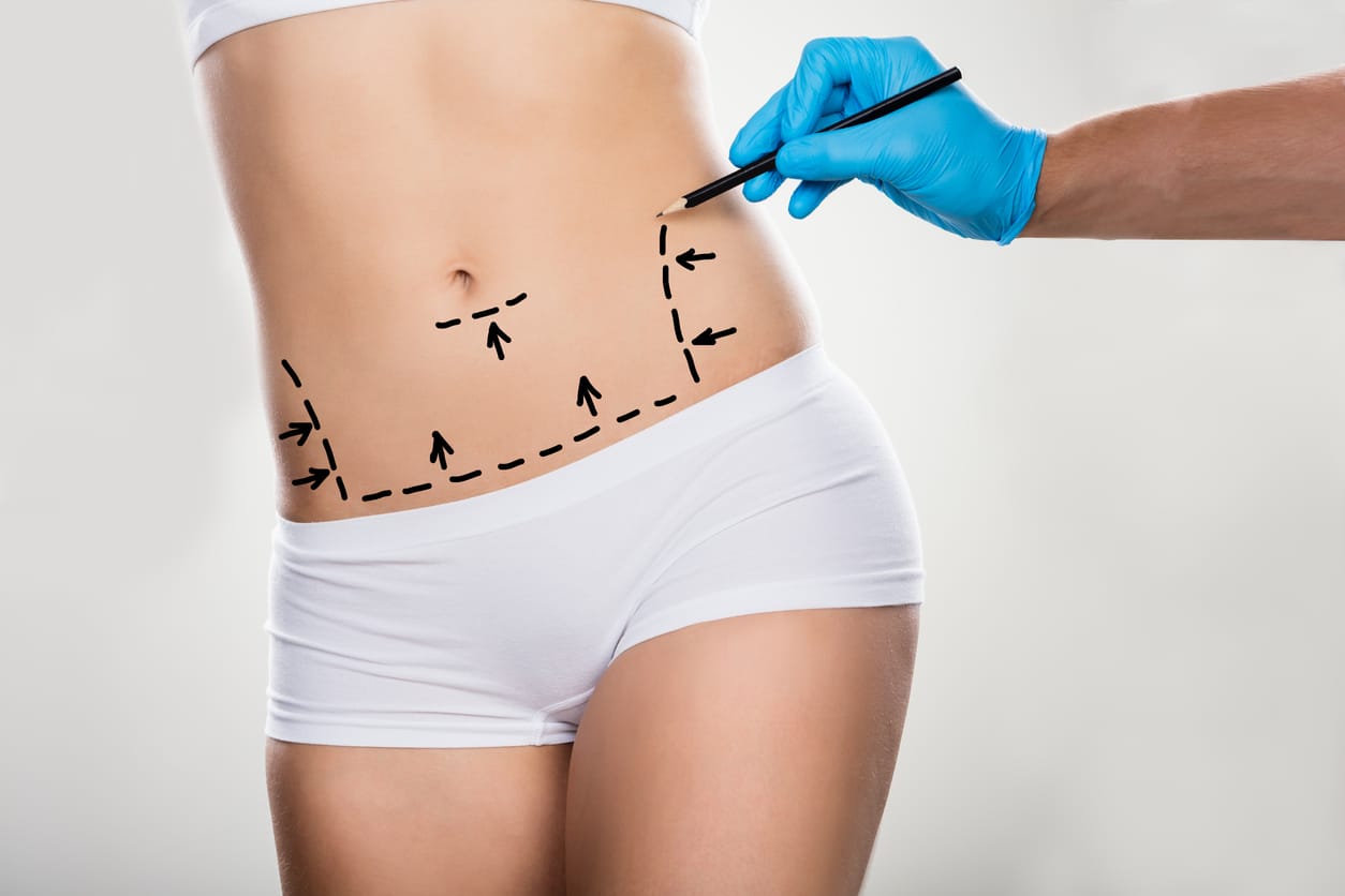 Liposuction of the abdomen and flanks, Plastic Surgeon San Francisco