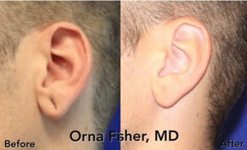 A before and after image set of a man that underwent earlobe repair surgery by Dr. Orna Fisher