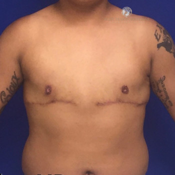 Female To Male Transgender Chest Reconstruction after photo. Individual results may vary.