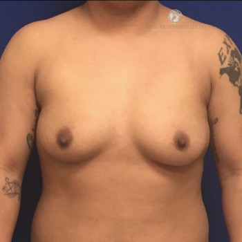 Female To Male Transgender Chest Reconstruction before photo. Individual results may vary.