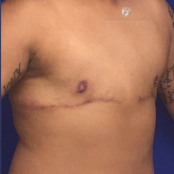 Female To Male Transgender Chest Reconstruction after photo. Individual results may vary.