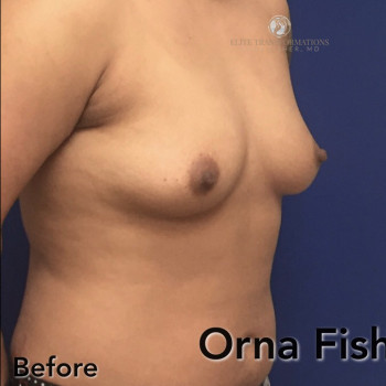 Female To Male Transgender Chest Reconstruction before photo. Individual results may vary.